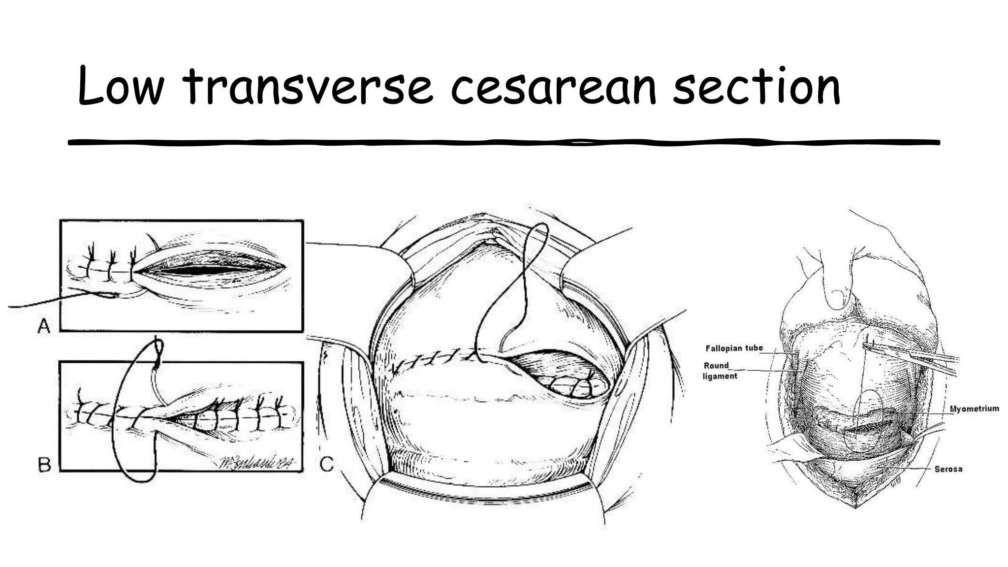 Low transverse cesarean section