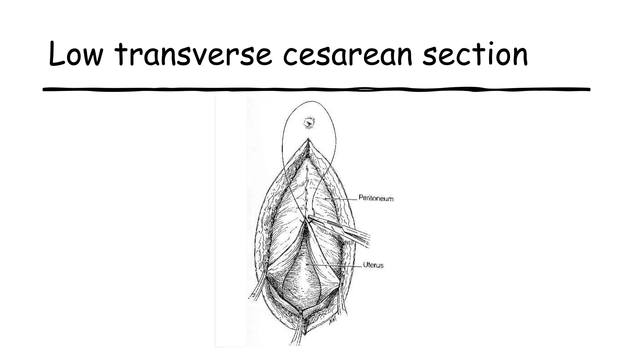 Low transverse cesarean section