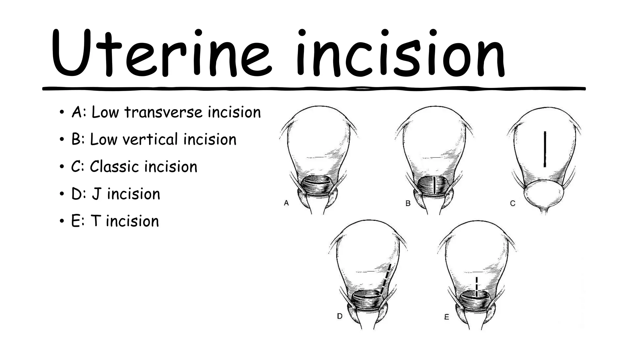 Uterine incision
• A: Low transverse incision
• B: Low vertical incision
• C: Classic incision
• D: J incision
• E: T incision