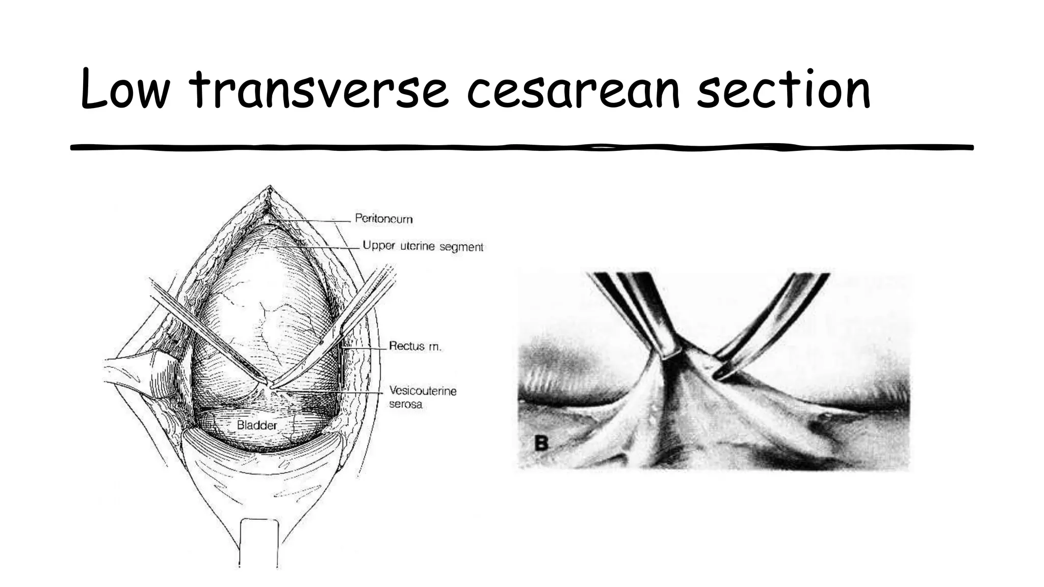 Low transverse cesarean section