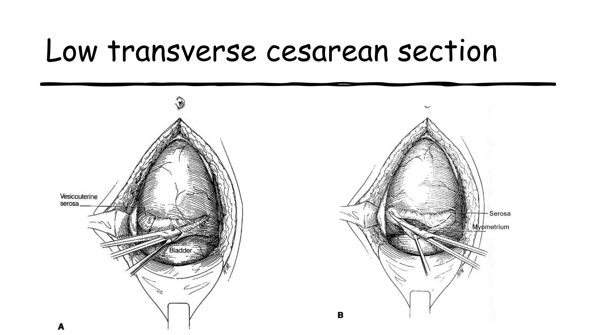 Low transverse cesarean section