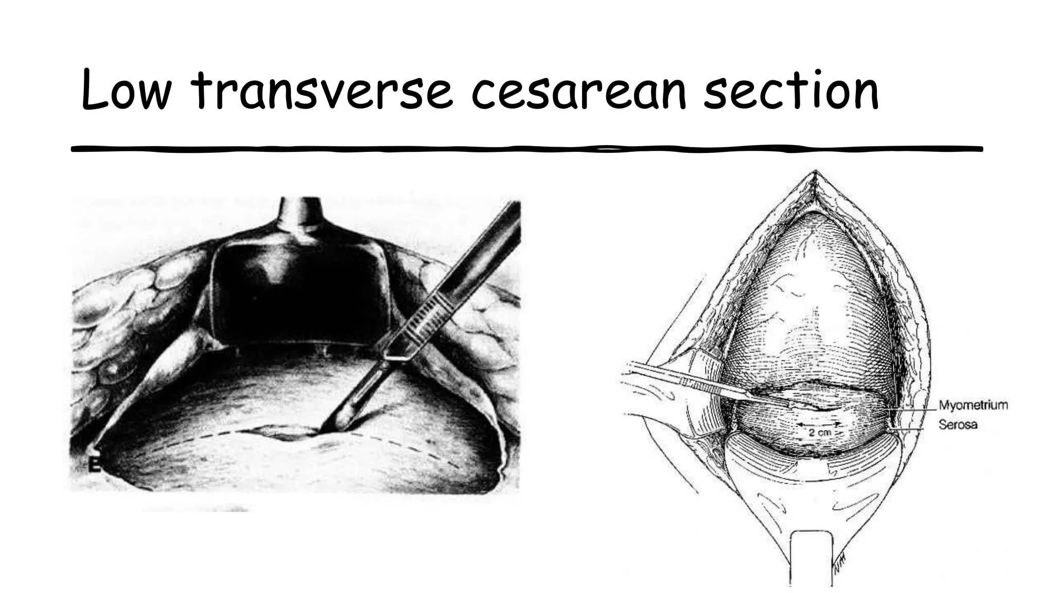 Low transverse cesarean section