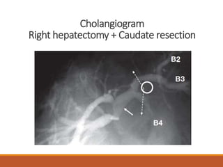 Cholangiogram
Right hepatectomy + Caudate resection
 
