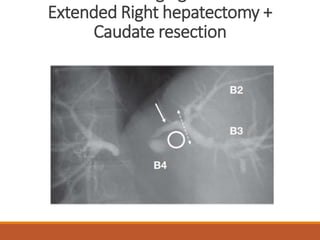 Extended Right hepatectomy +
Caudate resection
 