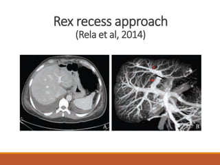 Rex recess approach
(Rela et al, 2014)
 