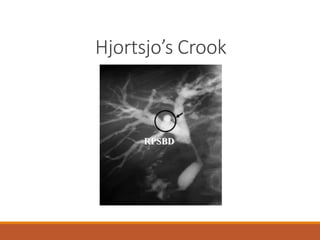 Hjortsjo’s Crook
 