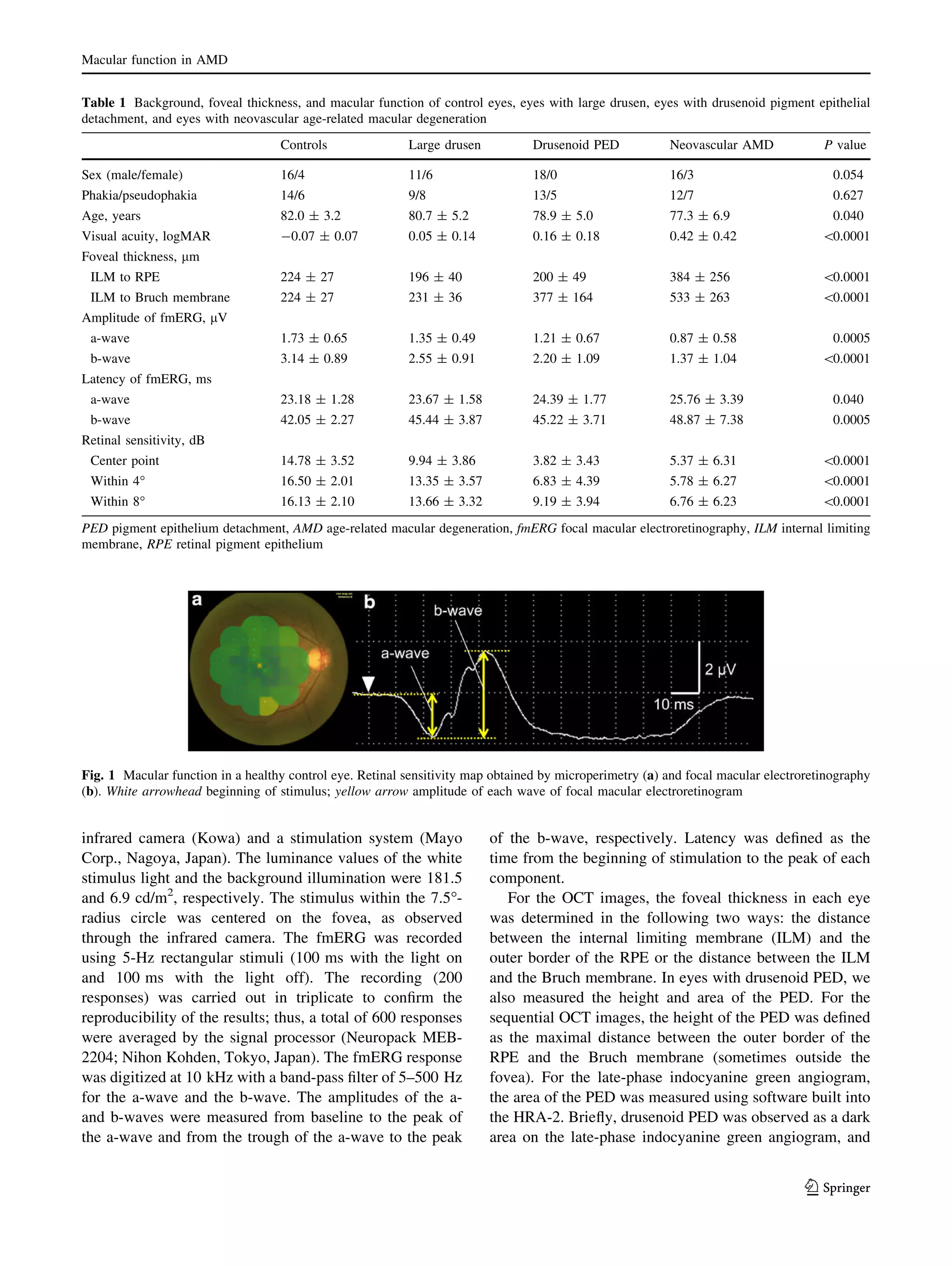 Macular function in AMD
Table 1 Background, foveal thickness, and macular function of control eyes, eyes with large drusen, eyes with drusenoid pigment epithelial
detachment, and eyes with neovascular age-related macular degeneration
Controls

Large drusen

Drusenoid PED

Neovascular AMD

P value

Sex (male/female)

16/4

11/6

18/0

16/3

Phakia/pseudophakia

14/6

9/8

13/5

12/7

0.627

Age, years

82.0 ± 3.2

80.7 ± 5.2

78.9 ± 5.0

77.3 ± 6.9

0.040

Visual acuity, logMAR

-0.07 ± 0.07

0.05 ± 0.14

0.16 ± 0.18

0.42 ± 0.42

0.0001

224 ± 27

196 ± 40

200 ± 49

384 ± 256

0.0001

224 ± 27

231 ± 36

377 ± 164

533 ± 263

0.0001

0.054

Foveal thickness, lm
ILM to RPE
ILM to Bruch membrane
Amplitude of fmERG, lV
a-wave

1.73 ± 0.65

1.35 ± 0.49

1.21 ± 0.67

0.87 ± 0.58

0.0005

b-wave

3.14 ± 0.89

2.55 ± 0.91

2.20 ± 1.09

1.37 ± 1.04

0.0001

Latency of fmERG, ms
a-wave

23.18 ± 1.28

23.67 ± 1.58

24.39 ± 1.77

25.76 ± 3.39

0.040

b-wave

42.05 ± 2.27

45.44 ± 3.87

45.22 ± 3.71

48.87 ± 7.38

0.0005

Center point

14.78 ± 3.52

9.94 ± 3.86

3.82 ± 3.43

5.37 ± 6.31

0.0001

Within 4°

16.50 ± 2.01

13.35 ± 3.57

6.83 ± 4.39

5.78 ± 6.27

0.0001

Within 8°

16.13 ± 2.10

13.66 ± 3.32

9.19 ± 3.94

6.76 ± 6.23

0.0001

Retinal sensitivity, dB

PED pigment epithelium detachment, AMD age-related macular degeneration, fmERG focal macular electroretinography, ILM internal limiting
membrane, RPE retinal pigment epithelium

Fig. 1 Macular function in a healthy control eye. Retinal sensitivity map obtained by microperimetry (a) and focal macular electroretinography
(b). White arrowhead beginning of stimulus; yellow arrow amplitude of each wave of focal macular electroretinogram

infrared camera (Kowa) and a stimulation system (Mayo
Corp., Nagoya, Japan). The luminance values of the white
stimulus light and the background illumination were 181.5
and 6.9 cd/m2, respectively. The stimulus within the 7.5°radius circle was centered on the fovea, as observed
through the infrared camera. The fmERG was recorded
using 5-Hz rectangular stimuli (100 ms with the light on
and 100 ms with the light off). The recording (200
responses) was carried out in triplicate to conﬁrm the
reproducibility of the results; thus, a total of 600 responses
were averaged by the signal processor (Neuropack MEB2204; Nihon Kohden, Tokyo, Japan). The fmERG response
was digitized at 10 kHz with a band-pass ﬁlter of 5–500 Hz
for the a-wave and the b-wave. The amplitudes of the aand b-waves were measured from baseline to the peak of
the a-wave and from the trough of the a-wave to the peak

of the b-wave, respectively. Latency was deﬁned as the
time from the beginning of stimulation to the peak of each
component.
For the OCT images, the foveal thickness in each eye
was determined in the following two ways: the distance
between the internal limiting membrane (ILM) and the
outer border of the RPE or the distance between the ILM
and the Bruch membrane. In eyes with drusenoid PED, we
also measured the height and area of the PED. For the
sequential OCT images, the height of the PED was deﬁned
as the maximal distance between the outer border of the
RPE and the Bruch membrane (sometimes outside the
fovea). For the late-phase indocyanine green angiogram,
the area of the PED was measured using software built into
the HRA-2. Brieﬂy, drusenoid PED was observed as a dark
area on the late-phase indocyanine green angiogram, and

123

 