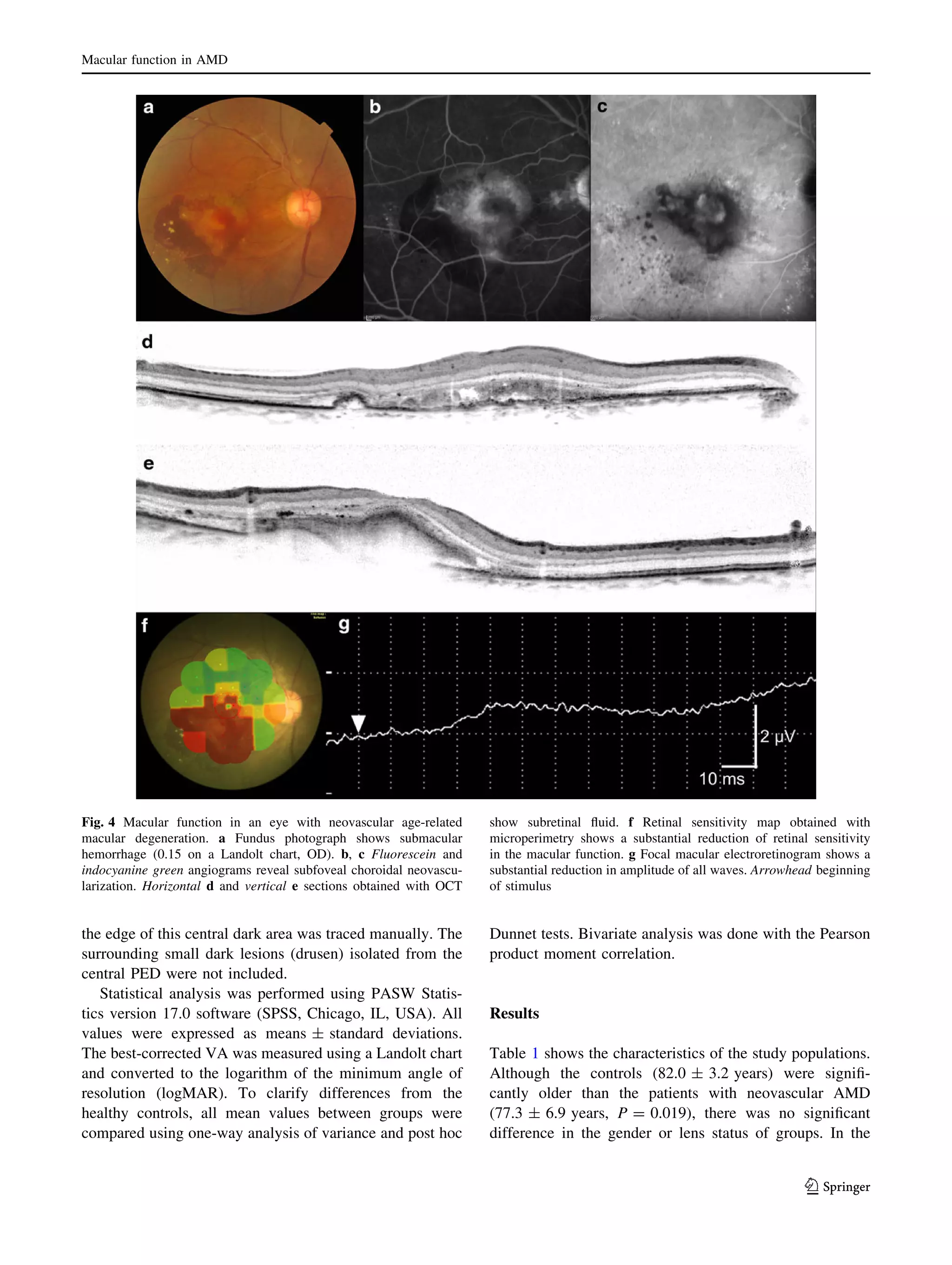 Macular function in AMD

Fig. 4 Macular function in an eye with neovascular age-related
macular degeneration. a Fundus photograph shows submacular
hemorrhage (0.15 on a Landolt chart, OD). b, c Fluorescein and
indocyanine green angiograms reveal subfoveal choroidal neovascularization. Horizontal d and vertical e sections obtained with OCT

show subretinal ﬂuid. f Retinal sensitivity map obtained with
microperimetry shows a substantial reduction of retinal sensitivity
in the macular function. g Focal macular electroretinogram shows a
substantial reduction in amplitude of all waves. Arrowhead beginning
of stimulus

the edge of this central dark area was traced manually. The
surrounding small dark lesions (drusen) isolated from the
central PED were not included.
Statistical analysis was performed using PASW Statistics version 17.0 software (SPSS, Chicago, IL, USA). All
values were expressed as means ± standard deviations.
The best-corrected VA was measured using a Landolt chart
and converted to the logarithm of the minimum angle of
resolution (logMAR). To clarify differences from the
healthy controls, all mean values between groups were
compared using one-way analysis of variance and post hoc

Dunnet tests. Bivariate analysis was done with the Pearson
product moment correlation.

Results
Table 1 shows the characteristics of the study populations.
Although the controls (82.0 ± 3.2 years) were signiﬁcantly older than the patients with neovascular AMD
(77.3 ± 6.9 years, P = 0.019), there was no signiﬁcant
difference in the gender or lens status of groups. In the

123

 