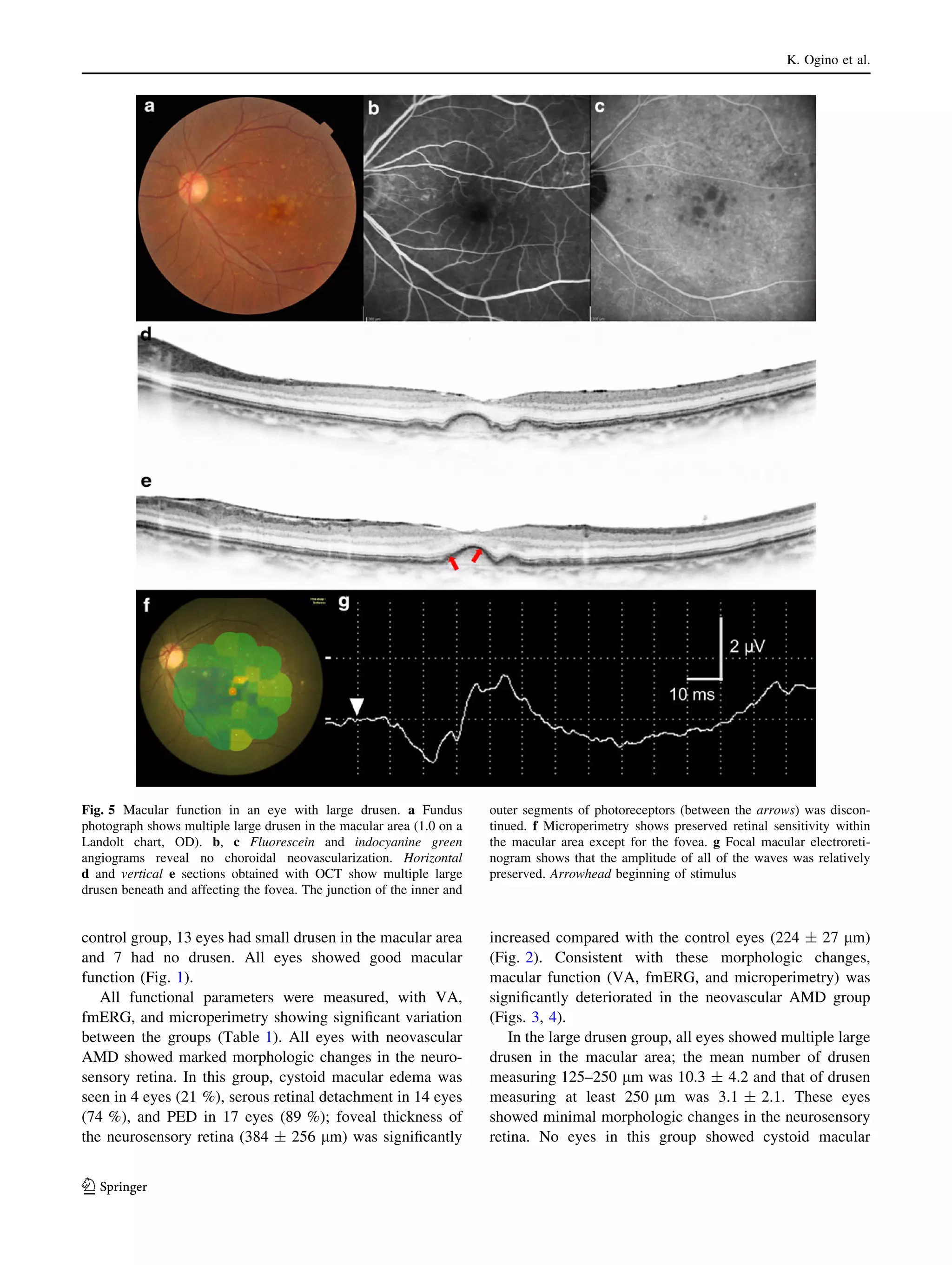 K. Ogino et al.

Fig. 5 Macular function in an eye with large drusen. a Fundus
photograph shows multiple large drusen in the macular area (1.0 on a
Landolt chart, OD). b, c Fluorescein and indocyanine green
angiograms reveal no choroidal neovascularization. Horizontal
d and vertical e sections obtained with OCT show multiple large
drusen beneath and affecting the fovea. The junction of the inner and

outer segments of photoreceptors (between the arrows) was discontinued. f Microperimetry shows preserved retinal sensitivity within
the macular area except for the fovea. g Focal macular electroretinogram shows that the amplitude of all of the waves was relatively
preserved. Arrowhead beginning of stimulus

control group, 13 eyes had small drusen in the macular area
and 7 had no drusen. All eyes showed good macular
function (Fig. 1).
All functional parameters were measured, with VA,
fmERG, and microperimetry showing signiﬁcant variation
between the groups (Table 1). All eyes with neovascular
AMD showed marked morphologic changes in the neurosensory retina. In this group, cystoid macular edema was
seen in 4 eyes (21 %), serous retinal detachment in 14 eyes
(74 %), and PED in 17 eyes (89 %); foveal thickness of
the neurosensory retina (384 ± 256 lm) was signiﬁcantly

increased compared with the control eyes (224 ± 27 lm)
(Fig. 2). Consistent with these morphologic changes,
macular function (VA, fmERG, and microperimetry) was
signiﬁcantly deteriorated in the neovascular AMD group
(Figs. 3, 4).
In the large drusen group, all eyes showed multiple large
drusen in the macular area; the mean number of drusen
measuring 125–250 lm was 10.3 ± 4.2 and that of drusen
measuring at least 250 lm was 3.1 ± 2.1. These eyes
showed minimal morphologic changes in the neurosensory
retina. No eyes in this group showed cystoid macular

123

 