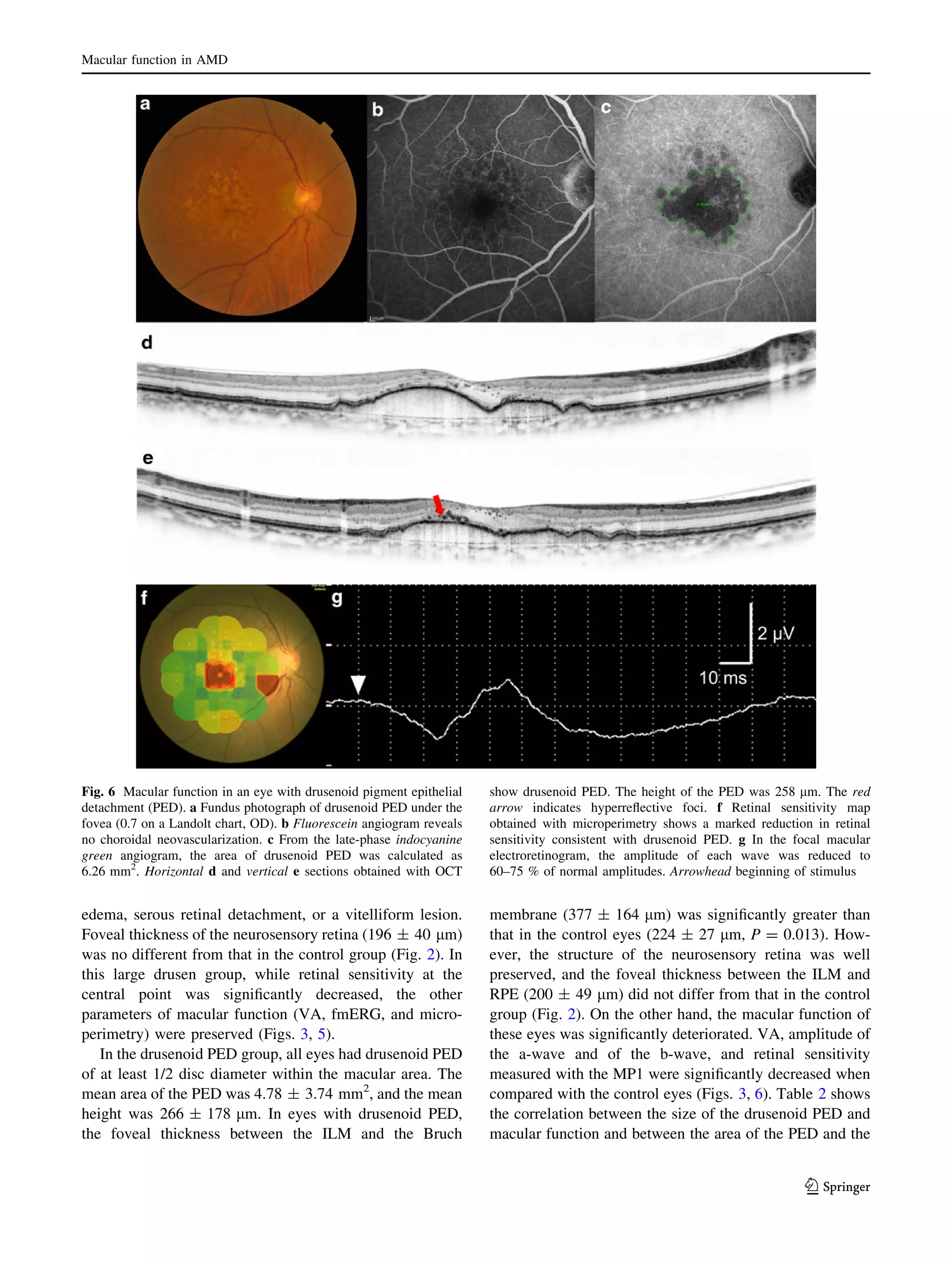 Macular function in AMD

Fig. 6 Macular function in an eye with drusenoid pigment epithelial
detachment (PED). a Fundus photograph of drusenoid PED under the
fovea (0.7 on a Landolt chart, OD). b Fluorescein angiogram reveals
no choroidal neovascularization. c From the late-phase indocyanine
green angiogram, the area of drusenoid PED was calculated as
6.26 mm2. Horizontal d and vertical e sections obtained with OCT

show drusenoid PED. The height of the PED was 258 lm. The red
arrow indicates hyperreﬂective foci. f Retinal sensitivity map
obtained with microperimetry shows a marked reduction in retinal
sensitivity consistent with drusenoid PED. g In the focal macular
electroretinogram, the amplitude of each wave was reduced to
60–75 % of normal amplitudes. Arrowhead beginning of stimulus

edema, serous retinal detachment, or a vitelliform lesion.
Foveal thickness of the neurosensory retina (196 ± 40 lm)
was no different from that in the control group (Fig. 2). In
this large drusen group, while retinal sensitivity at the
central point was signiﬁcantly decreased, the other
parameters of macular function (VA, fmERG, and microperimetry) were preserved (Figs. 3, 5).
In the drusenoid PED group, all eyes had drusenoid PED
of at least 1/2 disc diameter within the macular area. The
mean area of the PED was 4.78 ± 3.74 mm2, and the mean
height was 266 ± 178 lm. In eyes with drusenoid PED,
the foveal thickness between the ILM and the Bruch

membrane (377 ± 164 lm) was signiﬁcantly greater than
that in the control eyes (224 ± 27 lm, P = 0.013). However, the structure of the neurosensory retina was well
preserved, and the foveal thickness between the ILM and
RPE (200 ± 49 lm) did not differ from that in the control
group (Fig. 2). On the other hand, the macular function of
these eyes was signiﬁcantly deteriorated. VA, amplitude of
the a-wave and of the b-wave, and retinal sensitivity
measured with the MP1 were signiﬁcantly decreased when
compared with the control eyes (Figs. 3, 6). Table 2 shows
the correlation between the size of the drusenoid PED and
macular function and between the area of the PED and the

123

 