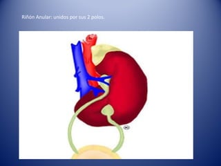 Riñón Anular: unidos por sus 2 polos.
 
