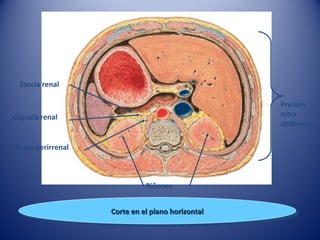 Corte en el plano horizontalCorte en el plano horizontalCorte en el plano horizontalCorte en el plano horizontal
Riñones
Fascia renal
Cápsula renal
Grasa perirrenal
Presión
Intra
abdominal
 