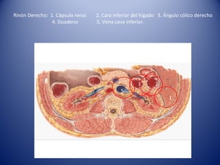 Rinón Derecho: 1. Cápsula renal. 2. Cara inferior del hígado 3. Ángulo cólico derecho
4. Duodeno 5. Vena cava inferior.
5
1
23
 