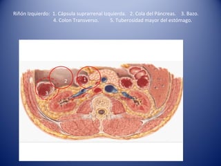 12
3
Riñón Izquierdo: 1. Cápsula suprarrenal Izquierda. 2. Cola del Páncreas. 3. Bazo.
4. Colon Transverso. 5. Tuberosidad mayor del estómago.
 
