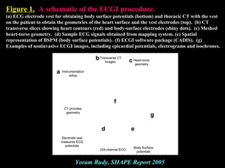 Figure 1. A schematic of the ECGI procedure.A schematic of the ECGI procedure.
(a) ECG electrode vest for obtaining body surface potentials (bottom) and thoracic CT with the vest
on the patient to obtain the geometries of the heart surface and the vest electrodes (top). (b) CT
transverse slices showing heart contours (red) and body-surface electrodes (shiny dots). (c) Meshed
heart-torso geometry. (d) Sample ECG signals obtained from mapping system. (e) Spatial
representation of BSPM (body surface potentials). (f) ECGI software package (CADIS). (g)
Examples of noninvasive ECGI images, including epicardial potentials, electrograms and isochrones.
Electrode vest
measures ECG
potentials
Instrumentation
setup
Transverse CT
Images
Body Surface
potentials
Heart-torso
geometry
224-channel ECG
CT provides
geometry
a
b c
d e
f
g
Electrode vest
measures ECG
potentials
Instrumentation
setup
Transverse CT
Images
Body Surface
potentials
Heart-torso
geometry
224-channel ECG
CT provides
geometry
a
b c
d e
f
g
Yoram Rudy, SHAPE Report 2005
 