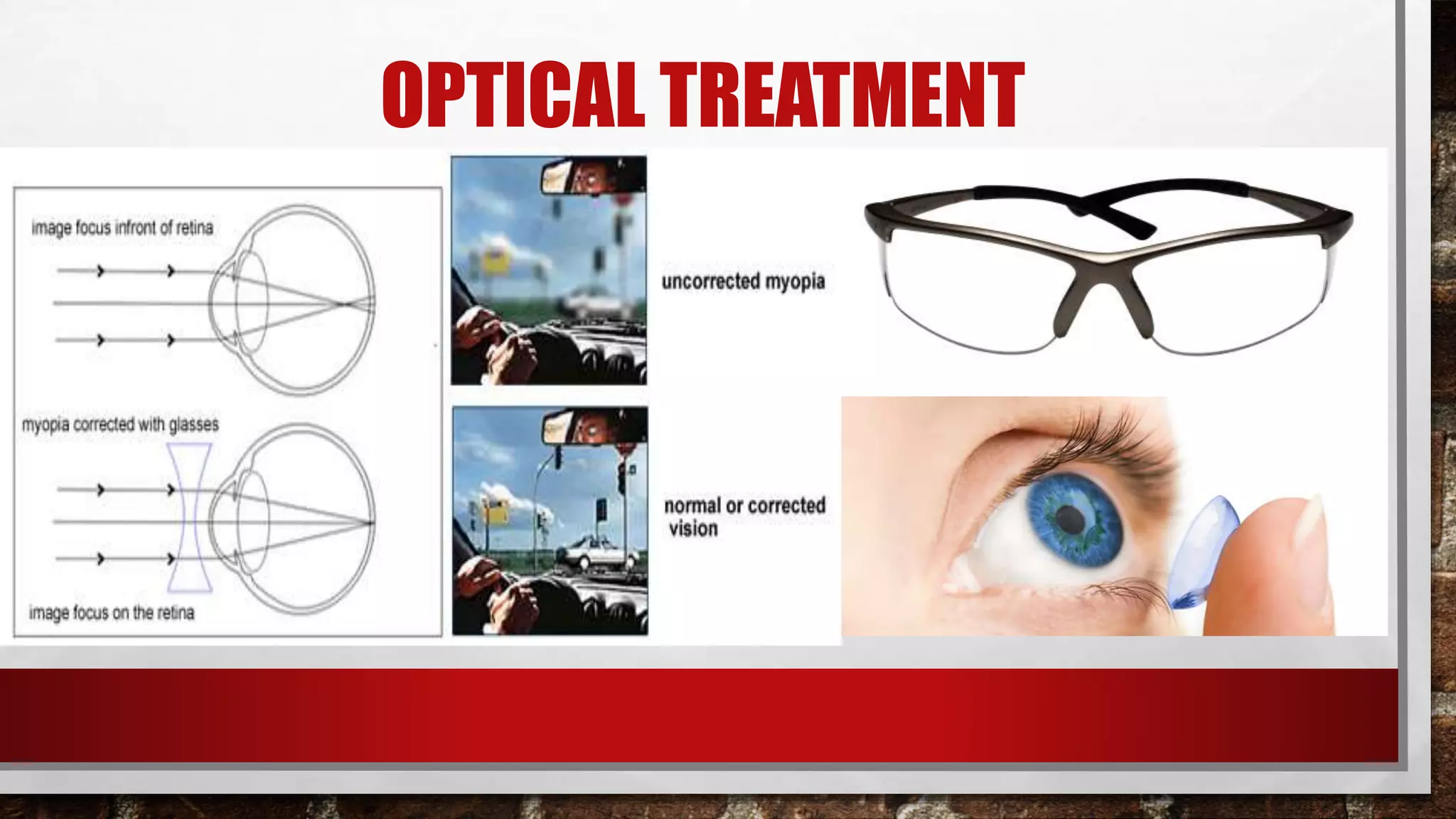 Pathological Myopia | PPTX