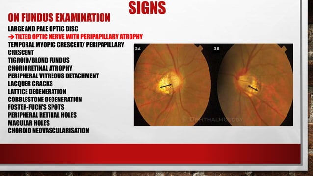 Pathological Myopia | PPTX