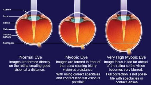 Pathological Myopia - 
