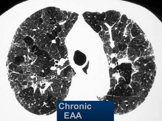 Chronic
EAA
 