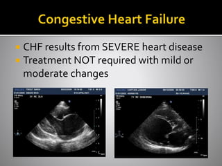  CHF results from SEVERE heart disease
 Treatment NOT required with mild or
moderate changes
 