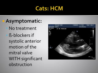  Asymptomatic:
 No treatment
 ß-blockers if
systolic anterior
motion of the
mitral valve
WITH significant
obstruction
 
