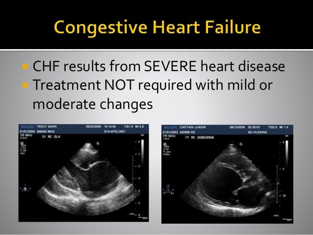 SASH Congestive Heart Failure by Dr Rita Singh
