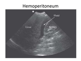 Hemoperitoneum
 
