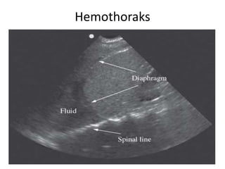 Hemothoraks
 
