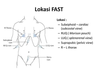 Lokasi FAST
• Lokasi :
– Subxiphoid – cardiac
(subcostal view)
– RUQ ( Morison pouch)
– LUQ ( splenorenal view)
– Suprapubic (pelvic view)
– R – L thorax
 