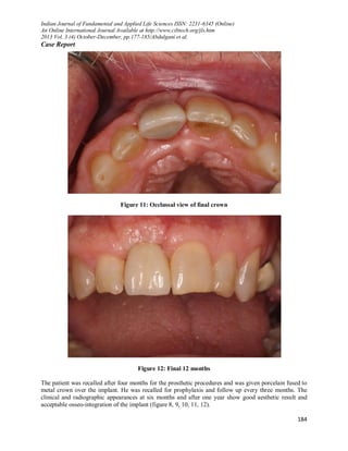 IMMEDIATE IMPLANT PLACEMENT WITH ONE YEAR FOLLOW-UP: A CASE REPORT | PDF