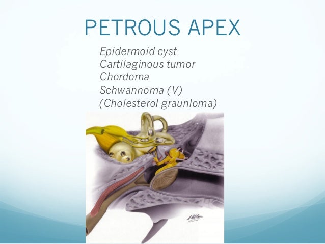 Jl sarrazin f benoudiba tumors of petrous bone jfim 2014