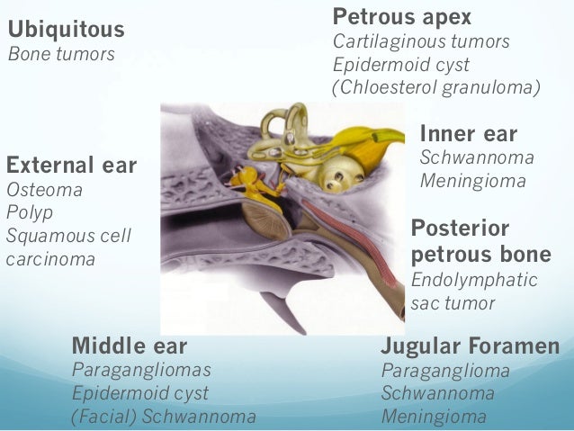 Jl sarrazin f benoudiba tumors of petrous bone jfim 2014