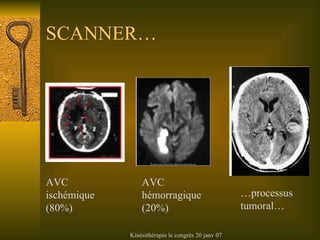 SCANNER… AVC ischémique (80%) AVC hémorragique (20%) … processus tumoral… 