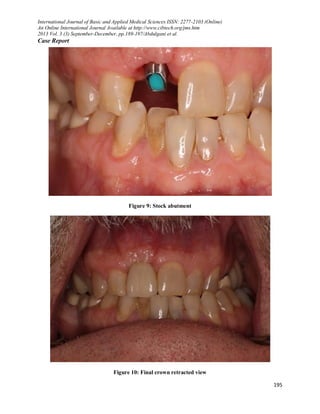 IMMEDIATE IMPLANT PLACEMENT WITH ONE YEAR FOLLOW-UP: A CASE REPORT | PDF