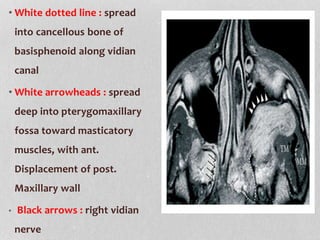 • White dotted line : spread
into cancellous bone of
basisphenoid along vidian
canal
• White arrowheads : spread
deep into pterygomaxillary
fossa toward masticatory
muscles, with ant.
Displacement of post.
Maxillary wall
• Black arrows : right vidian
nerve
 