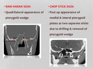 • RAM HARAN SIGN:
• Quadrilateral appearance of
pterygoid wedge
• CHOP STICK SIGN:
• Post op appearance of
medial & lateral pterygoid
plates as two separate sticks
due to drilling & removal of
pterygoid wedge
 