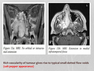 Rich vascularity of tumour gives rise to typical small dotted flow voids
(salt pepper appearance)
 