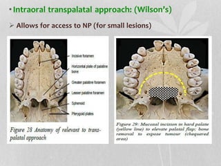 •Intraoral transpalatal approach: (Wilson’s)
 Allows for access to NP (for small lesions)
 