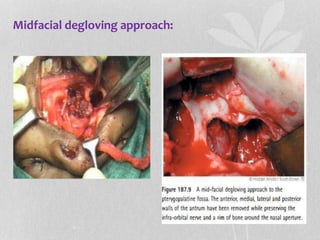 Midfacial degloving approach:
 