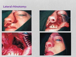 Lateral rhinotomy:
 