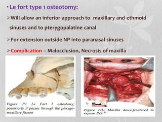 •Le fort type 1 osteotomy:
Will allow an inferior approach to maxillary and ethmoid
sinuses and to pterygopalatine canal
For extension outside NP into paranasal sinuses
Complication – Malocclusion, Necrosis of maxilla
 
