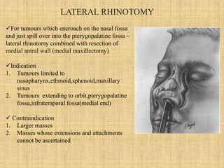Nasal Rhinotomy Jna(juvenile nasopharyngeal angiofibroma) current treatment modalities ...