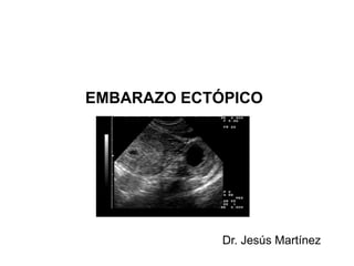 EMBARAZO ECTÓPICO
Dr. Jesús Martínez
 