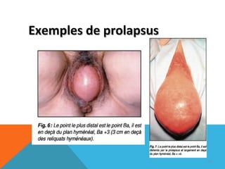 EExxeemmpplleess ddee pprroollaappssuuss 
98 
 