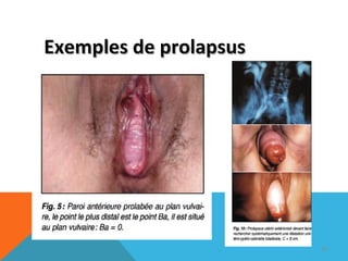 EExxeemmpplleess ddee pprroollaappssuuss 
99 
 