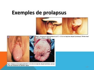 EExxeemmpplleess ddee pprroollaappssuuss 
100 
 