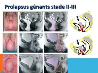 PPrroollaappssuuss ggêênnaannttss ssttaaddee IIII--IIIIII 
103 
 