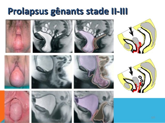 Imaging for spondylolisthesis picture