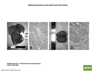 Adenocarcinoma and small cell carcinoma.
K Miyamoto et al. J Neurol Neurosurg Psychiatry
2002;72:408-409
©2002 by BMJ Publishing Group Ltd
 