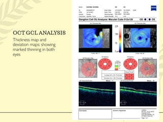 Normal Gcl Map Case of juvenile open angle glaucoma and it’s management | PDF